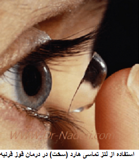 استفاده از لنز تماسی هارد (سخت) در درمان قوز قرنیه