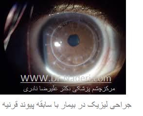 lasik and corneal transplantation لیزیک در بیمار با سابقه پیوند قرنیه