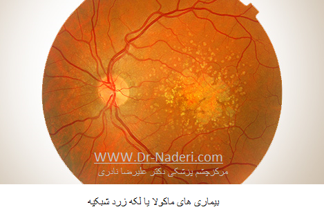 macular disease بیماری های ماکولا