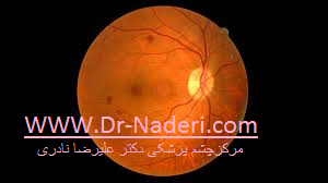 cystoid macular edema causes علل ادم ماکولا 