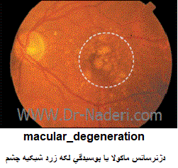  دژنرسانس ماکولا یا پوسیدگی لکه زرد شبکیه چشم