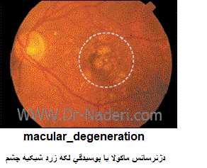 macular degeneration دژنراسیون لکه زرد شبکیه