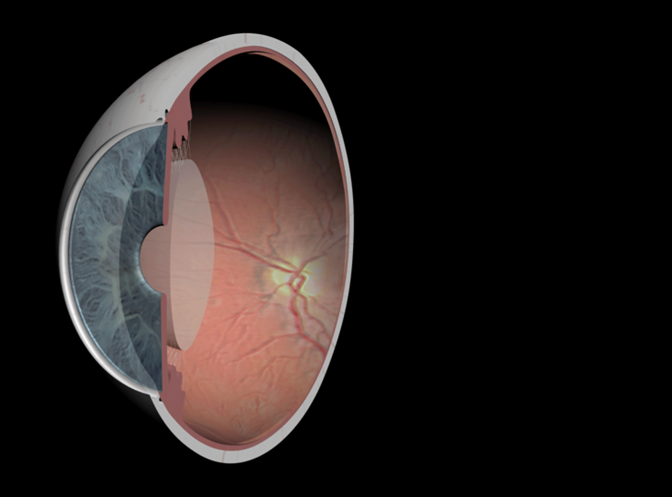 normal crystallyne lens عدشس طبیعی چشم