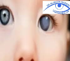 آب مروارید کودکان pediatric  cataract
