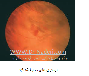 perpheral retinal disease بیماری های محیطی شبکیه