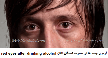 قرمزی چشم ها در مصرف کنندگان الکل red eyes after drinking alcohol