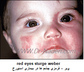  red eyes sturge weber  قرمزی چشم ها در بیماری استورج - وبر