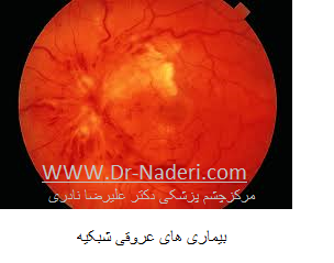 retinal vascular disease بیماری های عروقی شبکیه