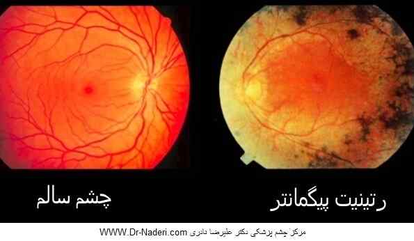 retinitis-pigmentosa-RPرتینیت پیگمنتوزا 