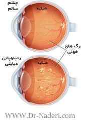 Diabetic eye problems دیابت و چشم 