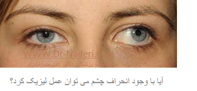 Strabismus and Laser Eye Surgery استرابیسم و جراحی لیزیک