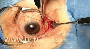 http://dr-naderi.com/article/203/%D8%AA%DB%8C%D8%B1%D9%88%D8%A6%DB%8C%D8%AF-%D9%88-%DA%86%D8%B4%D9%85-thyroid-eye-disease