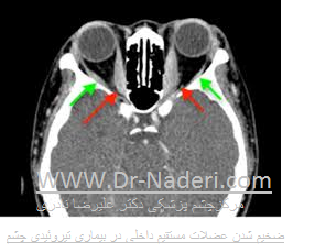 thyroeid eye disease ct scan سی تی اسکن بیماری تیروئیدی چشم 