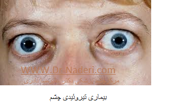 thyroid eye disease بیماری تیروئیدی چشم