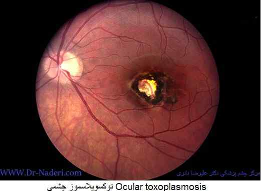 توکسوپلاسموز چشمي Ocular toxoplasmosis