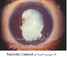آب مروارید ضربه ای traumatic Cataract